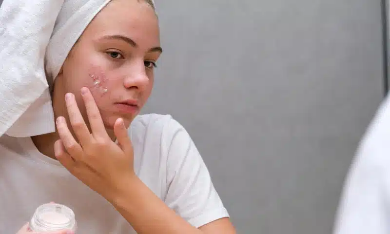 Como tratar el acné