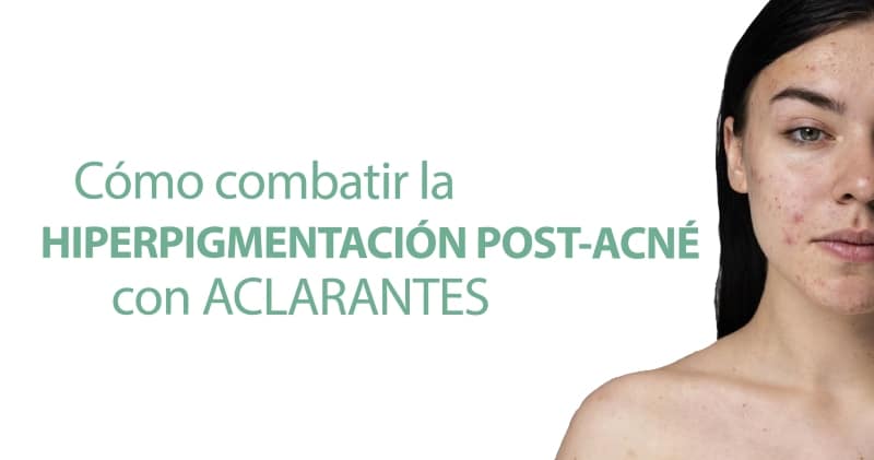 Hiperpigmentación post-acné: Cómo combatirla con aclarantes