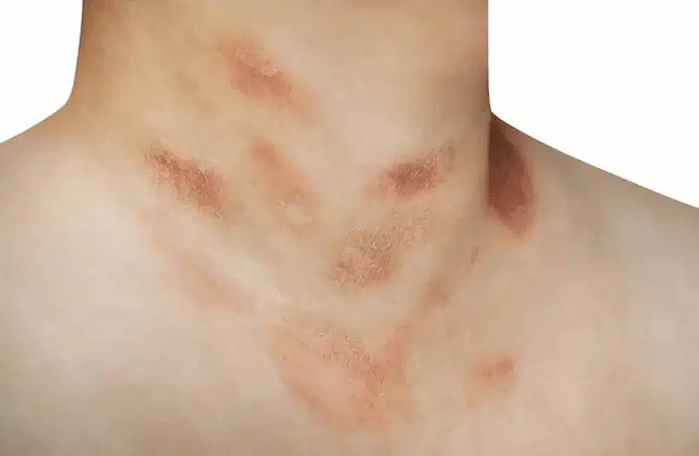 Manchas en el cuello y escote: causas comunes y cómo aclararlas manchas en el cuello